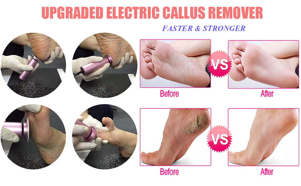 callus_foot_remover.jpg